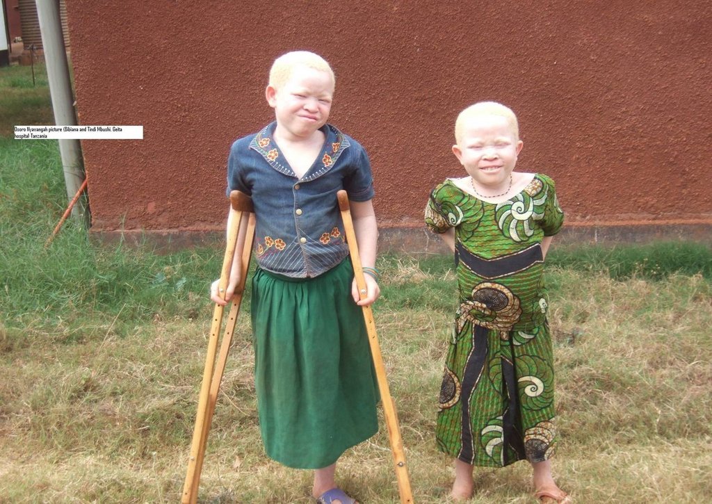 Save 150 Albino Person from Skin Cancer inTanzania