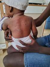 Dermatosis Pruginea  on child at APF Fondwa Clinic
