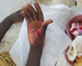 Emergency Hand Wound at APF Fondwa Clinic