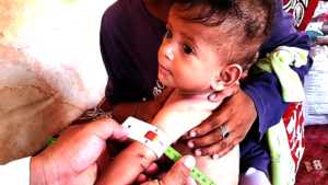 Measuring malnutrition levels in children