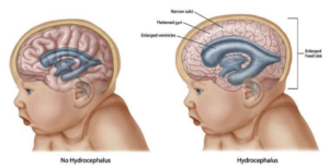 Preventing Congenital Hydrocephalus in Mexico