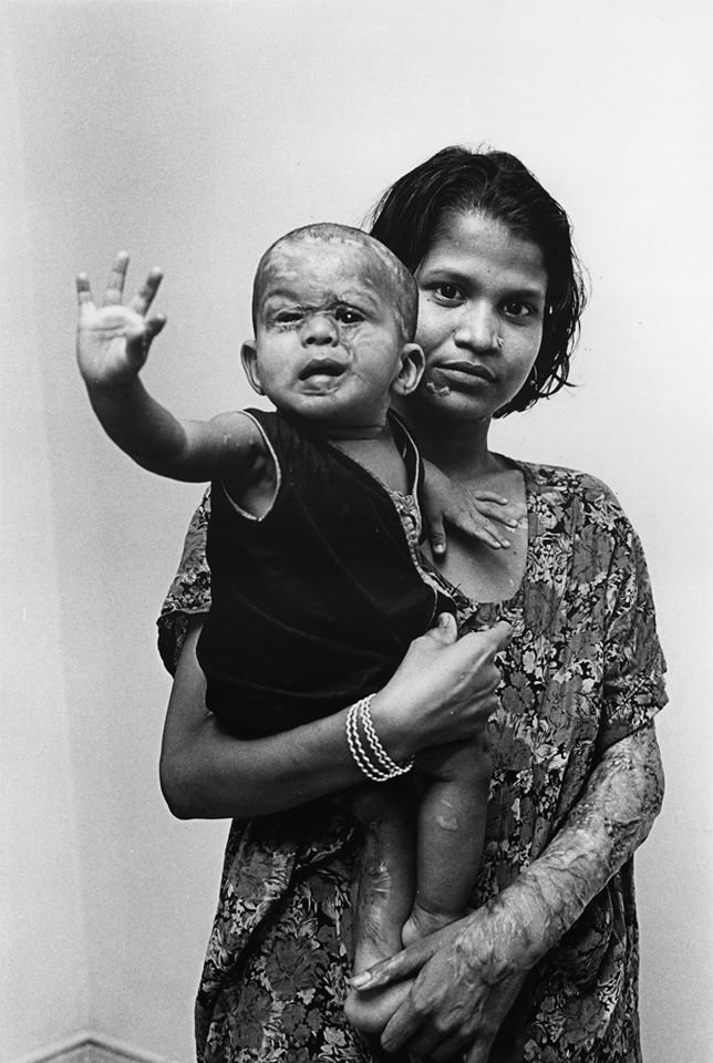 Hospital Care for 350 Acid Victims in Bangladesh