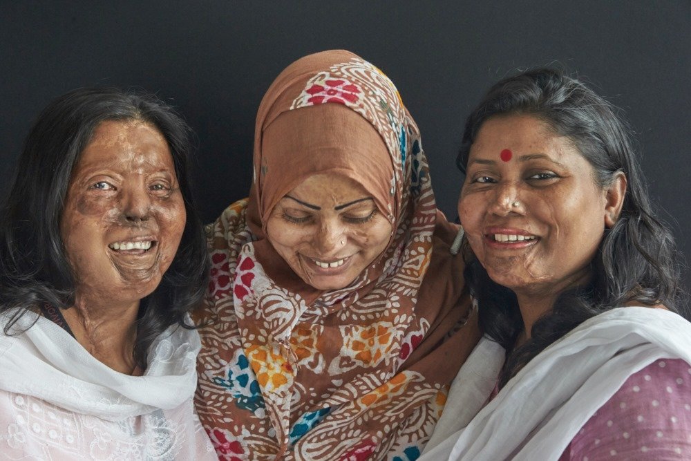 Hospital Care for 350 Acid Victims in Bangladesh