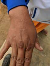 Hand Healed 1 Year Later, Minimal Scarring