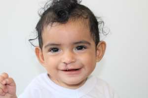 Liam's healthy smile 48 hours after surgery!
