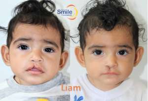 Liam - before and after surgery