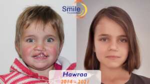 Hawraa is growing up with a healthy & happy smile!