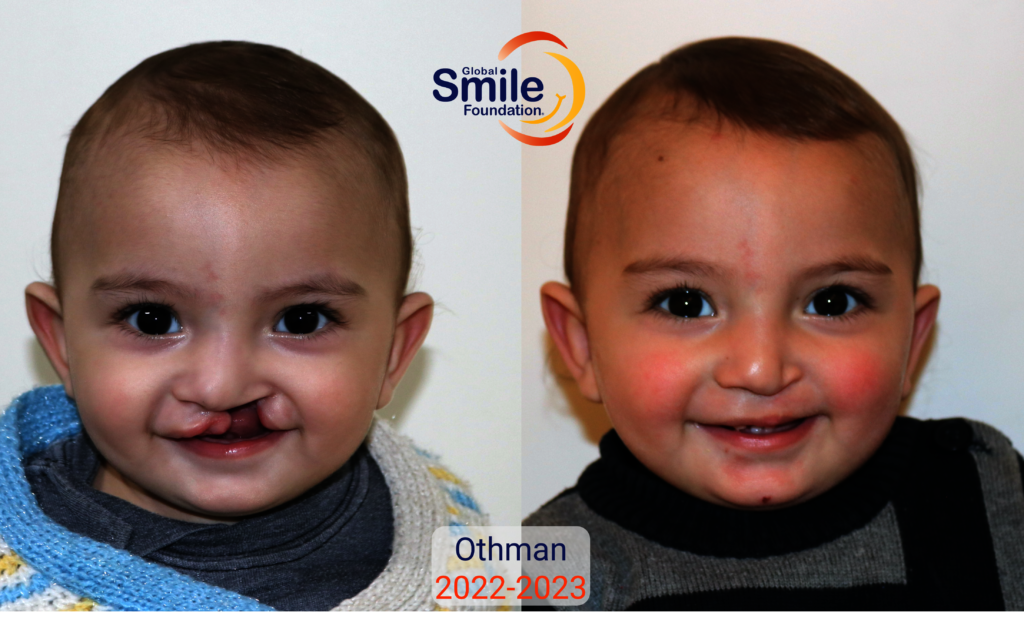 Othman's Smile