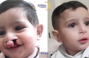 Provide Cleft Care for 10 Children in Lebanon