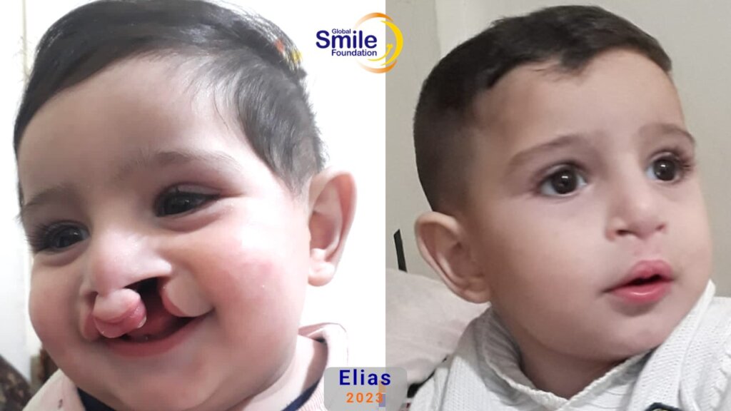 Provide Cleft Care for 10 Children in Lebanon