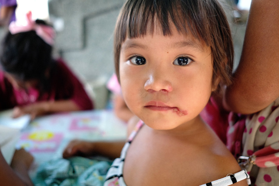 The children with the skin problem on the face