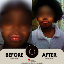 Severe skin disease