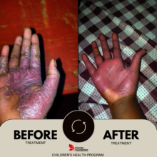 Severe skin disease