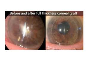 Before and after Corneal Graft