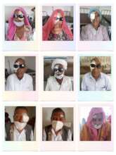 Cataract Operated Patient Jodhpur Rajasthan