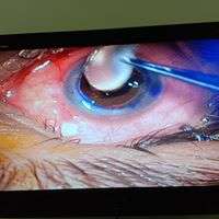 Use of New High Tech machine for Caretoplasty