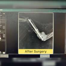 After Surgery with the pinning