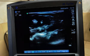 detected Urolithiasis