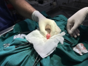 stone removed from the urinary track