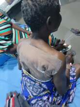 Post Surgery-Lipoma Patient