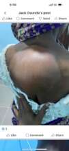 OIUSA 2023 MM_Pre-Surgery Lipoma Pix
