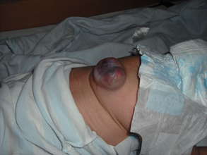 Pre-op spina bifida infant, Little ZLY