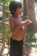 Malnutrition