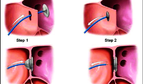 Diagram of closure of the hole in the heart