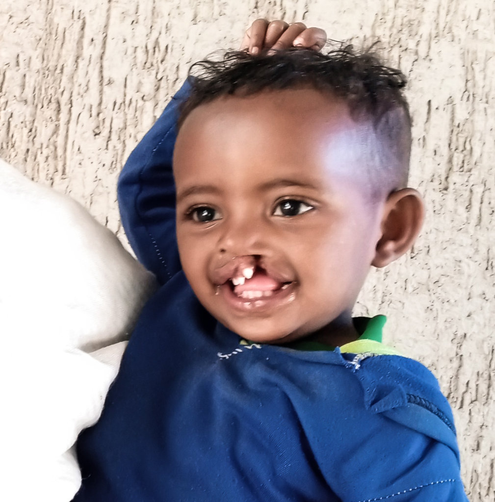 Provide safe access to 25 cleft surgeries
