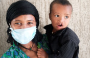 Provide safe access to 25 cleft surgeries