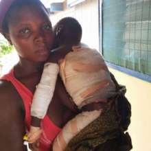 child fell in hot boiling  water