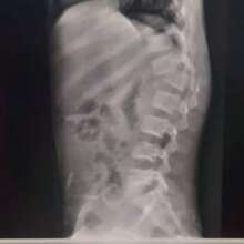 spinal xray for Osman