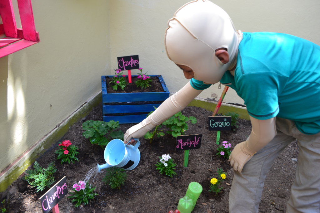 Let's give hope to 150 burned children in Peru