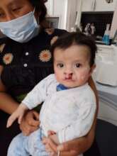 Baby boy after his operation