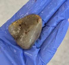 The rock that doctors removed to save him