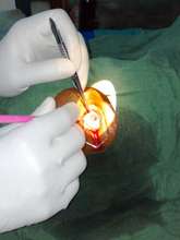 Cataract Operation