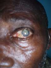 Cataract Patient
