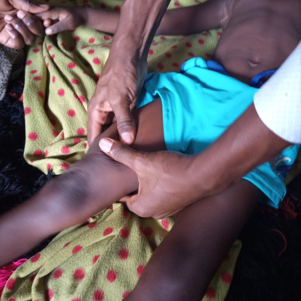 Restore Lives of 100 Children with Disabilities.