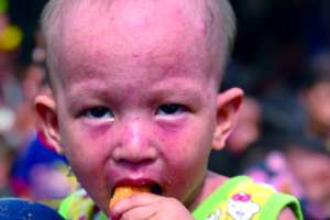 The child who have skin disease