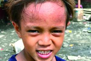 The child who have skin disease