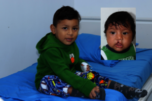 Angel in 2022, 3 years after his first surgery!