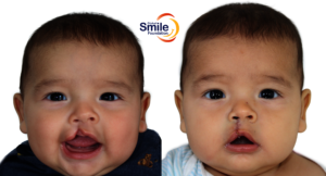 Joel, pictured before & 48 hours after surgery