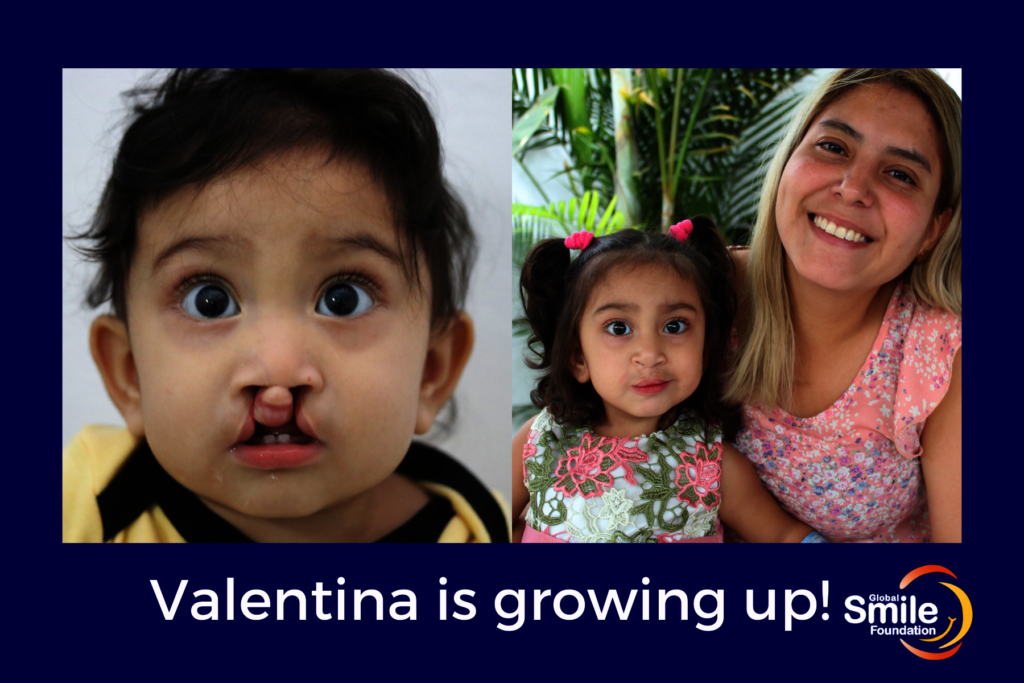 Healthy lives for children with cleft in Ecuador