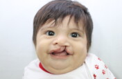 Healthy lives for children with cleft in Ecuador