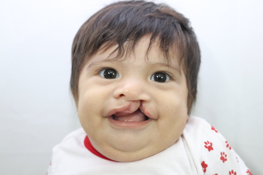 Healthy lives for children with cleft in Ecuador
