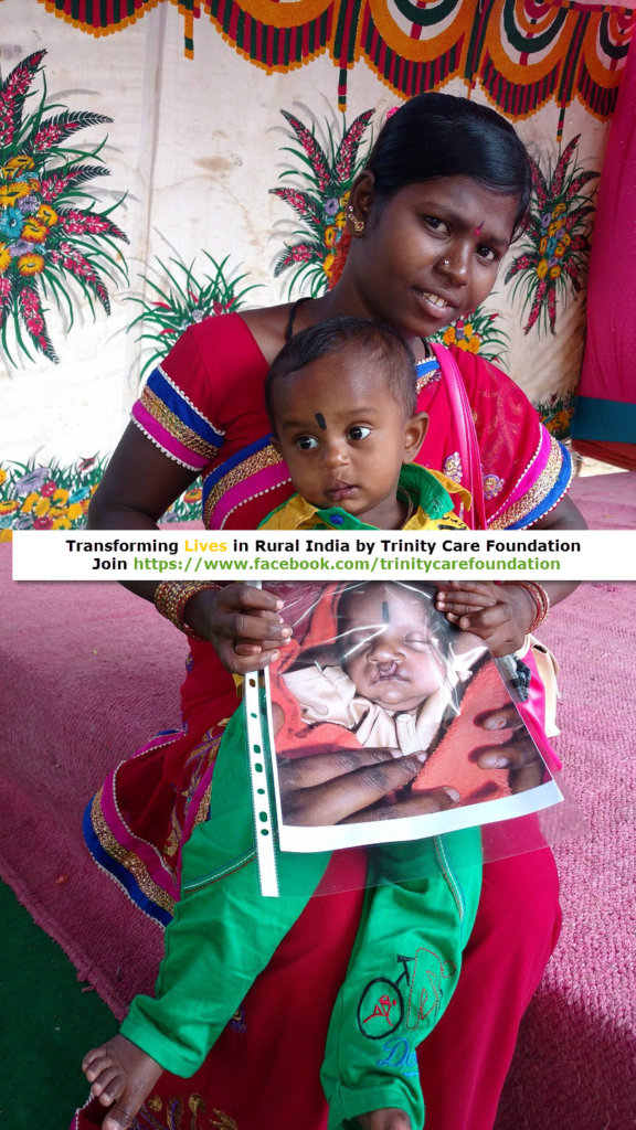 Gift a Smile to 75 Cleft Children in India