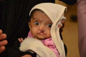 Child with Cleft Lip and Cleft Palate