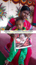 Free Cleft Lip surgery India