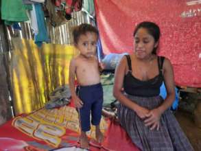 2 year old Axel with malnutrition and his young mo