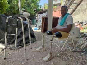 Bilateral Prosthetics patient